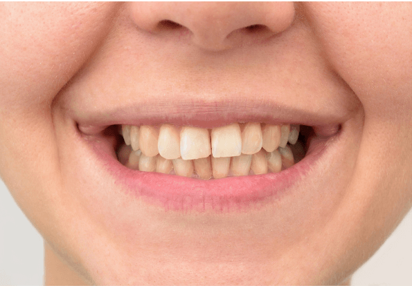 A close up of a woman 's teeth with a smile on her face.