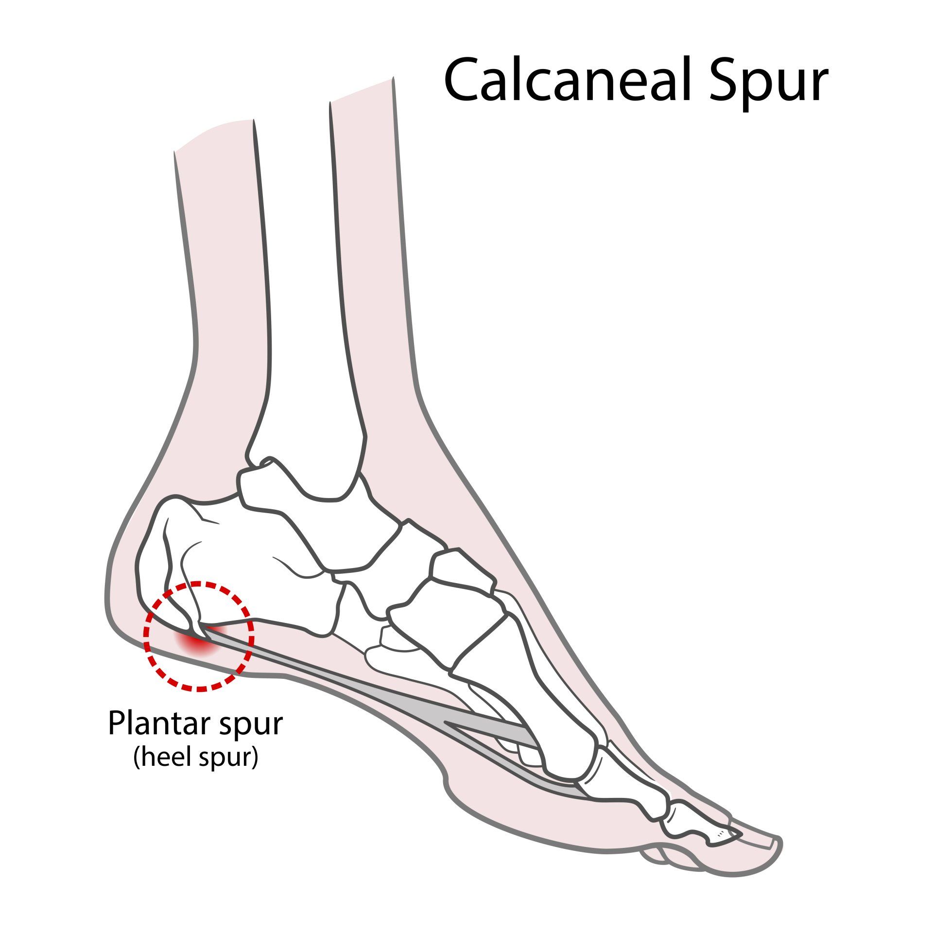 Image of Heel Spurs — Brockton, MA — JW Podiatry