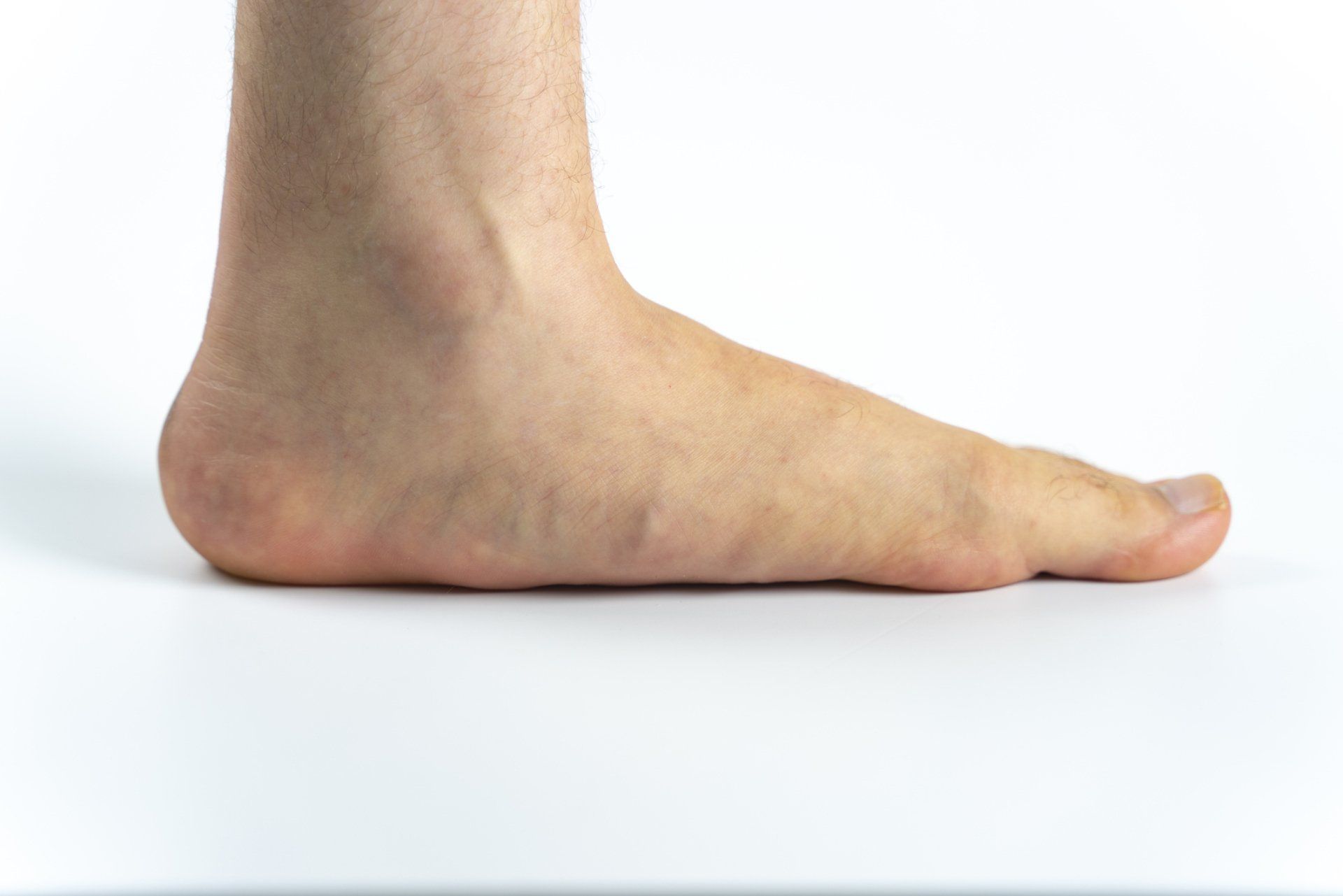 FlatFeet — Brockton, MA — JW Podiatry