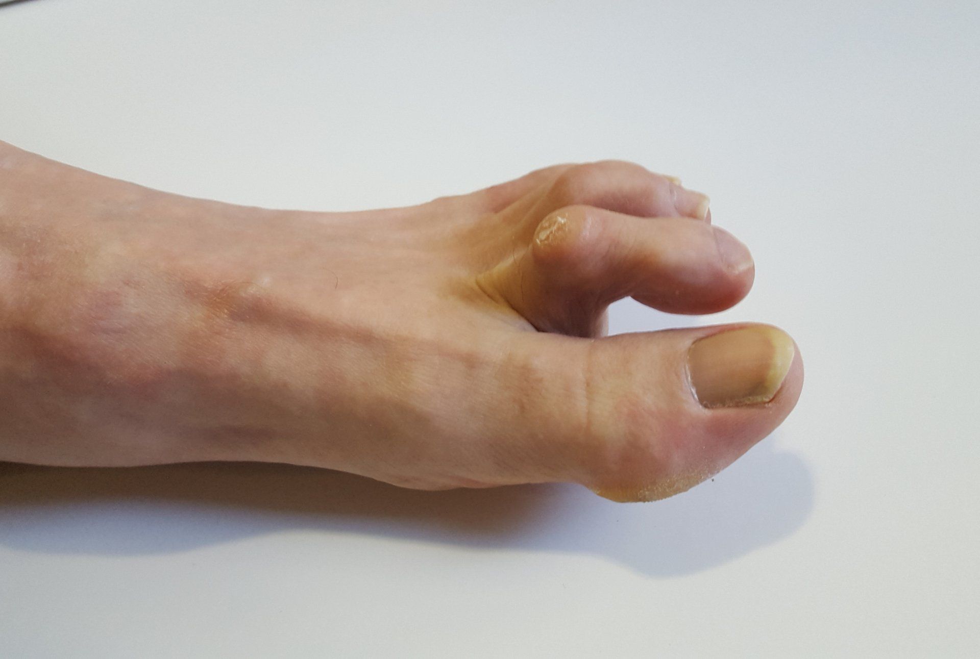 Hammertoes — Brockton, MA — JW Podiatry