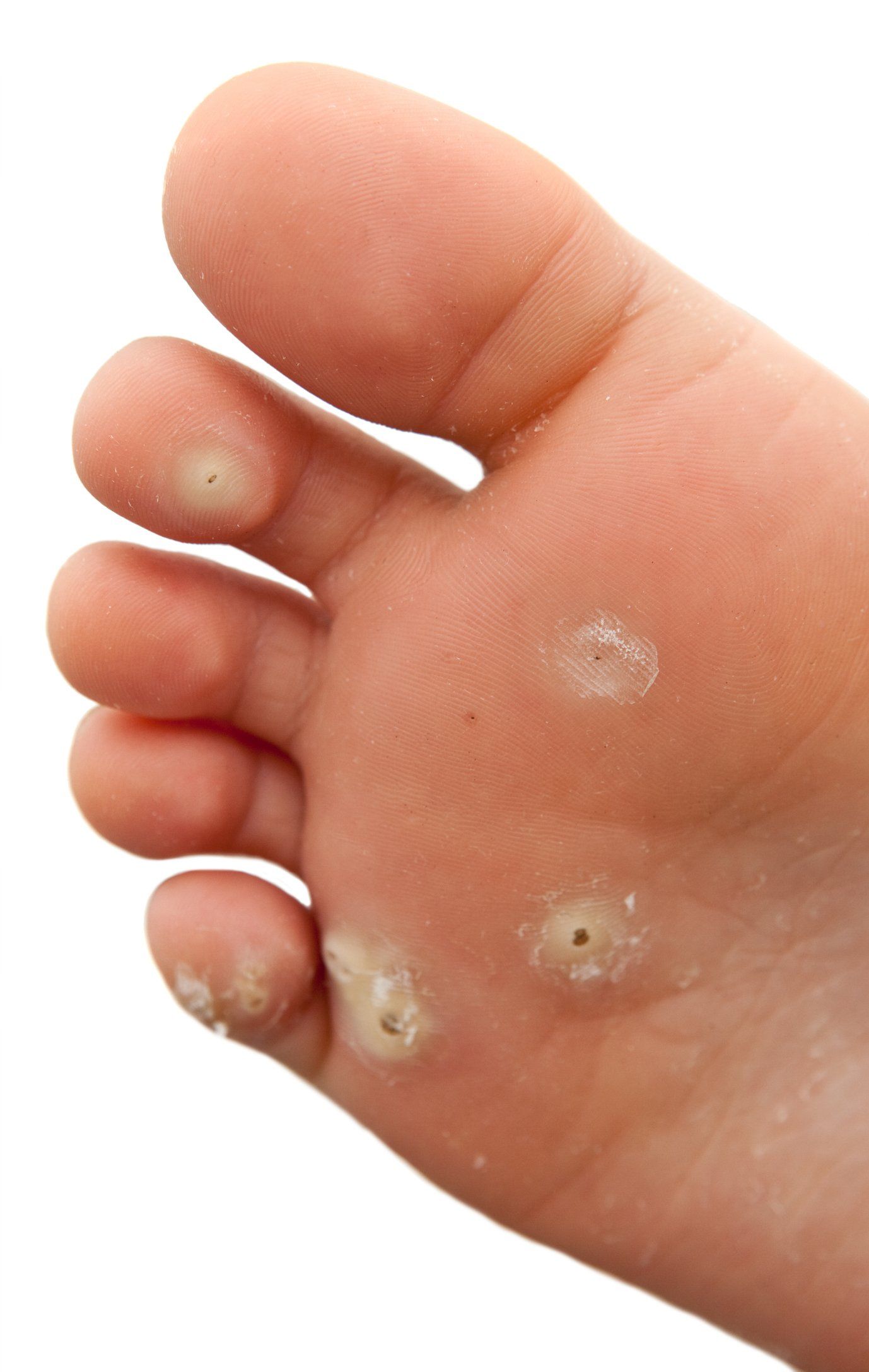 Foot With Planter's Wart — Brockton, MA — JW Podiatry