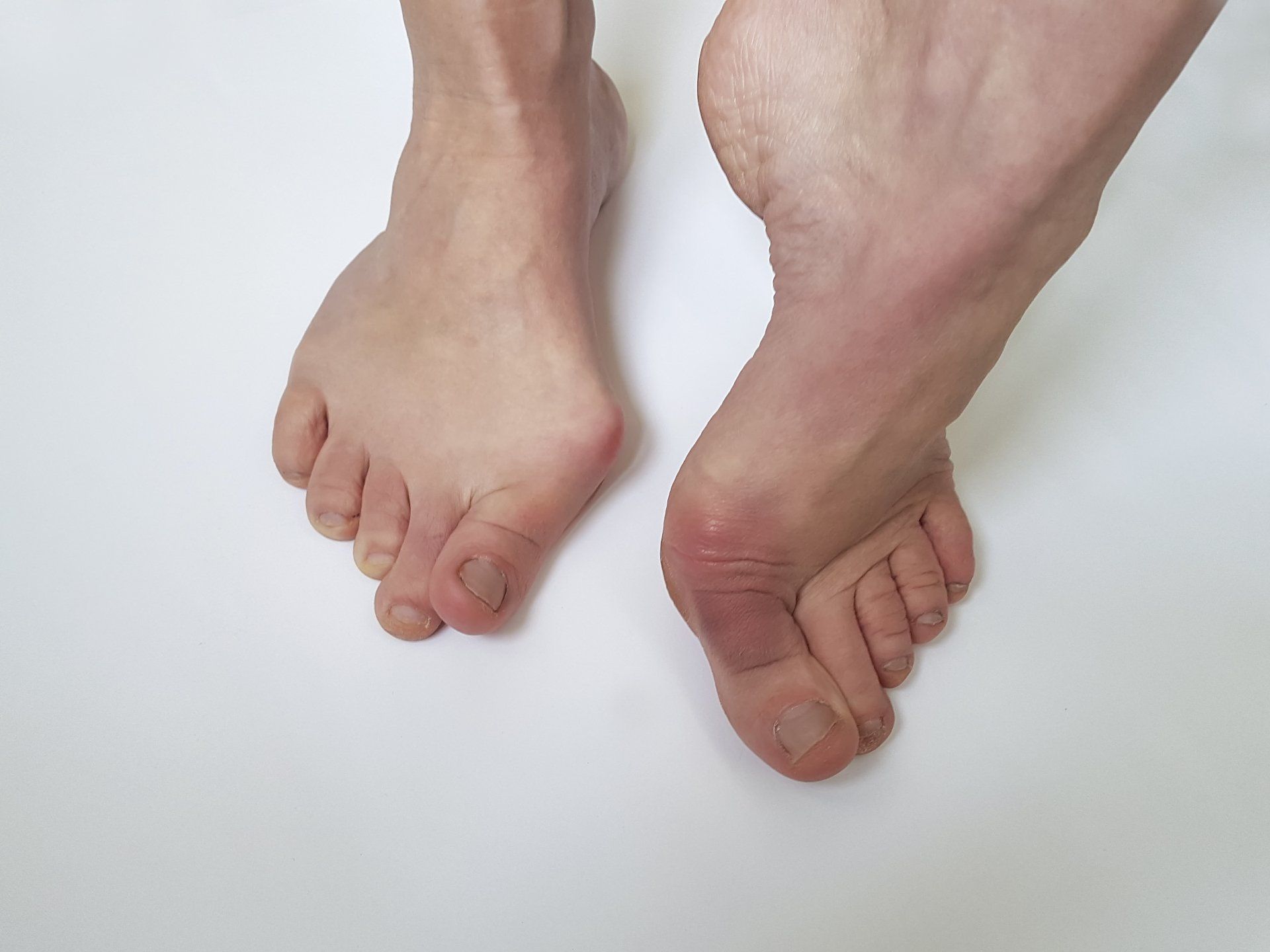 Bubbled Water With Foot Deformities — Brockton, MA — JW Podiatry
