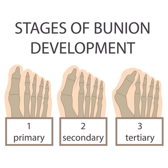 Stages Of Bunion Development Image — Brockton, MA — JW Podiatry