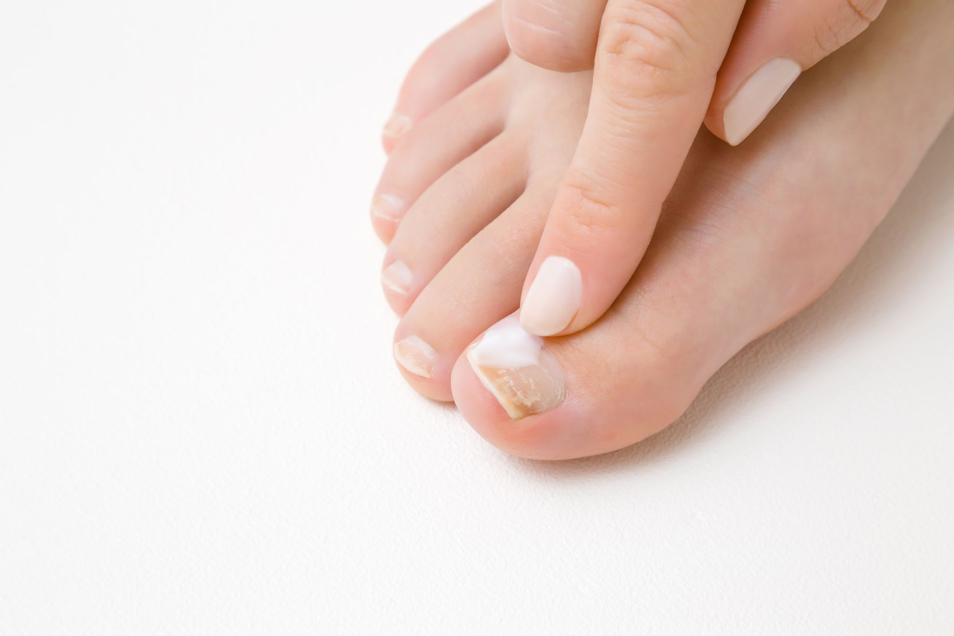 Foot with fungal infection being examined by a hand with light pink nail polish.