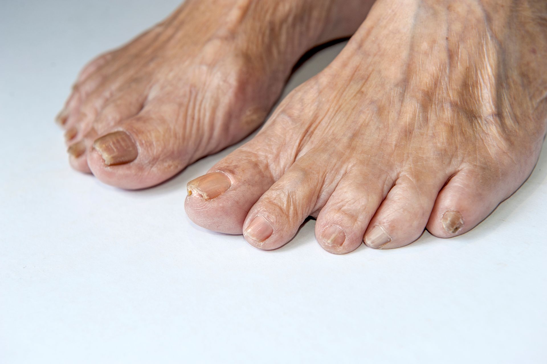 Close-up of elderly feet with wrinkled skin and discolored toenails on a white surface.