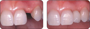 A before and after picture of a person 's teeth