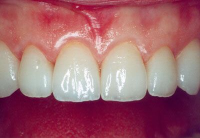 A close up of a person 's teeth and gums.