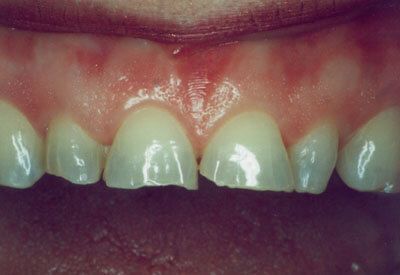 A close up of a person 's teeth with a broken tooth.