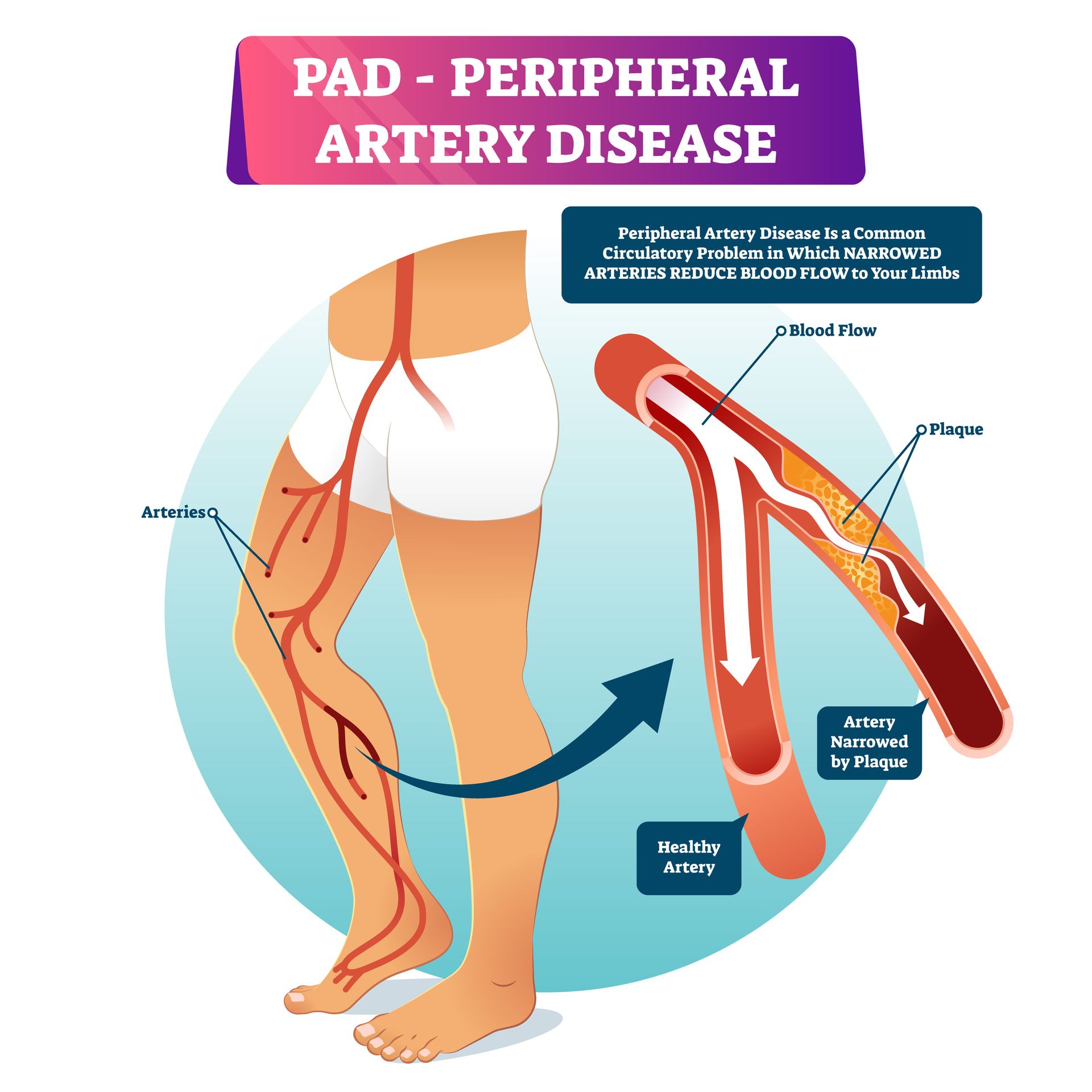 Infographic of PAD peripheral artery disease showing narrowed leg arteries and reduced blood flow in the lower limb