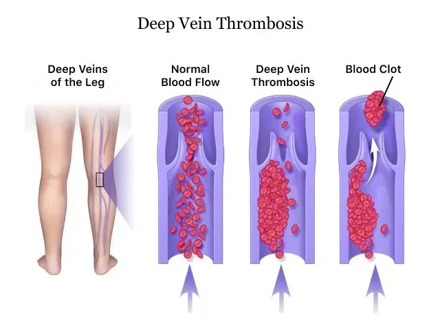 Deep Vein thrombosis diagram of normal blood flow vs blood flow with DVT