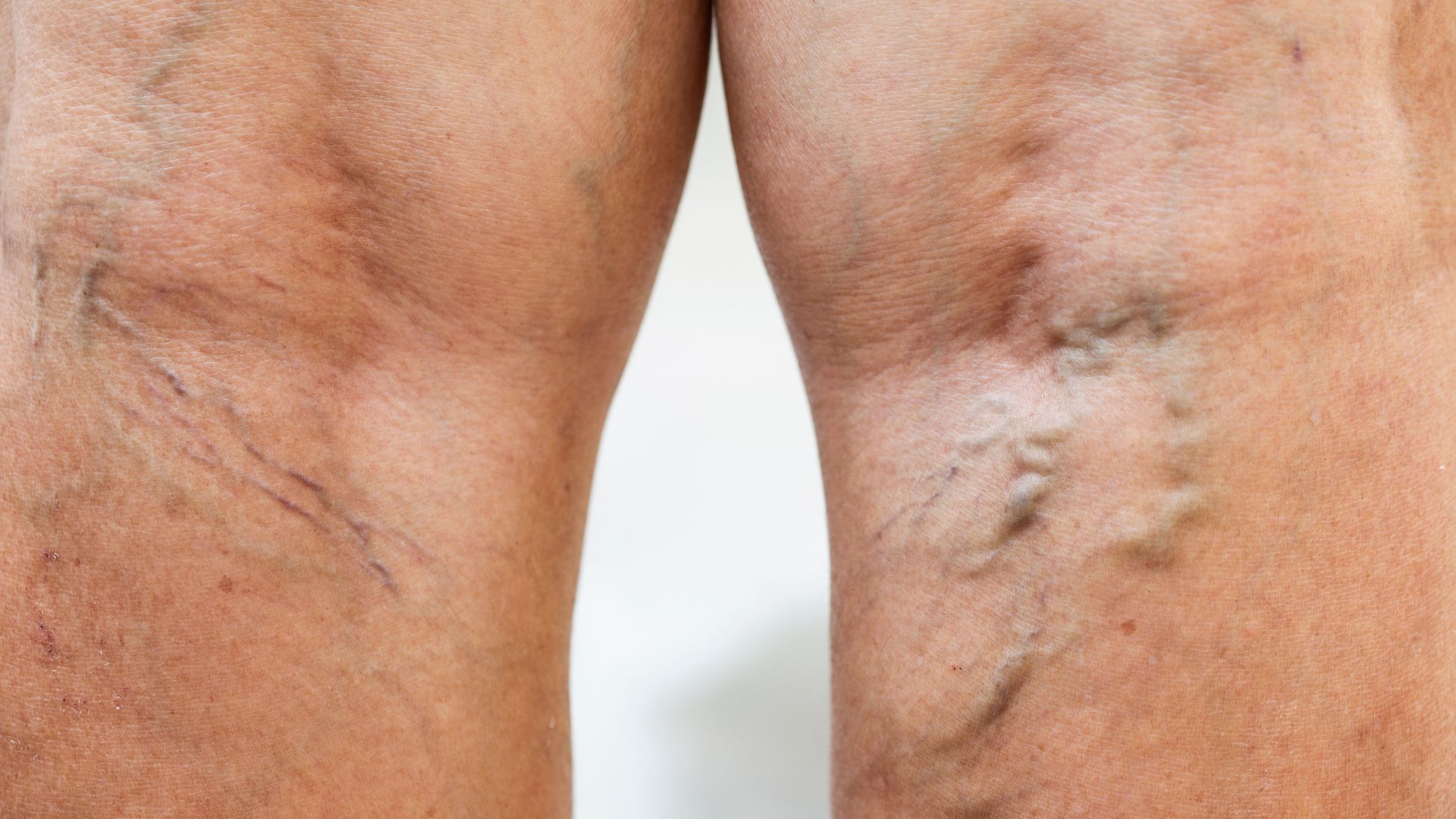 Close-up of two legs with varicose veins and skin discoloration