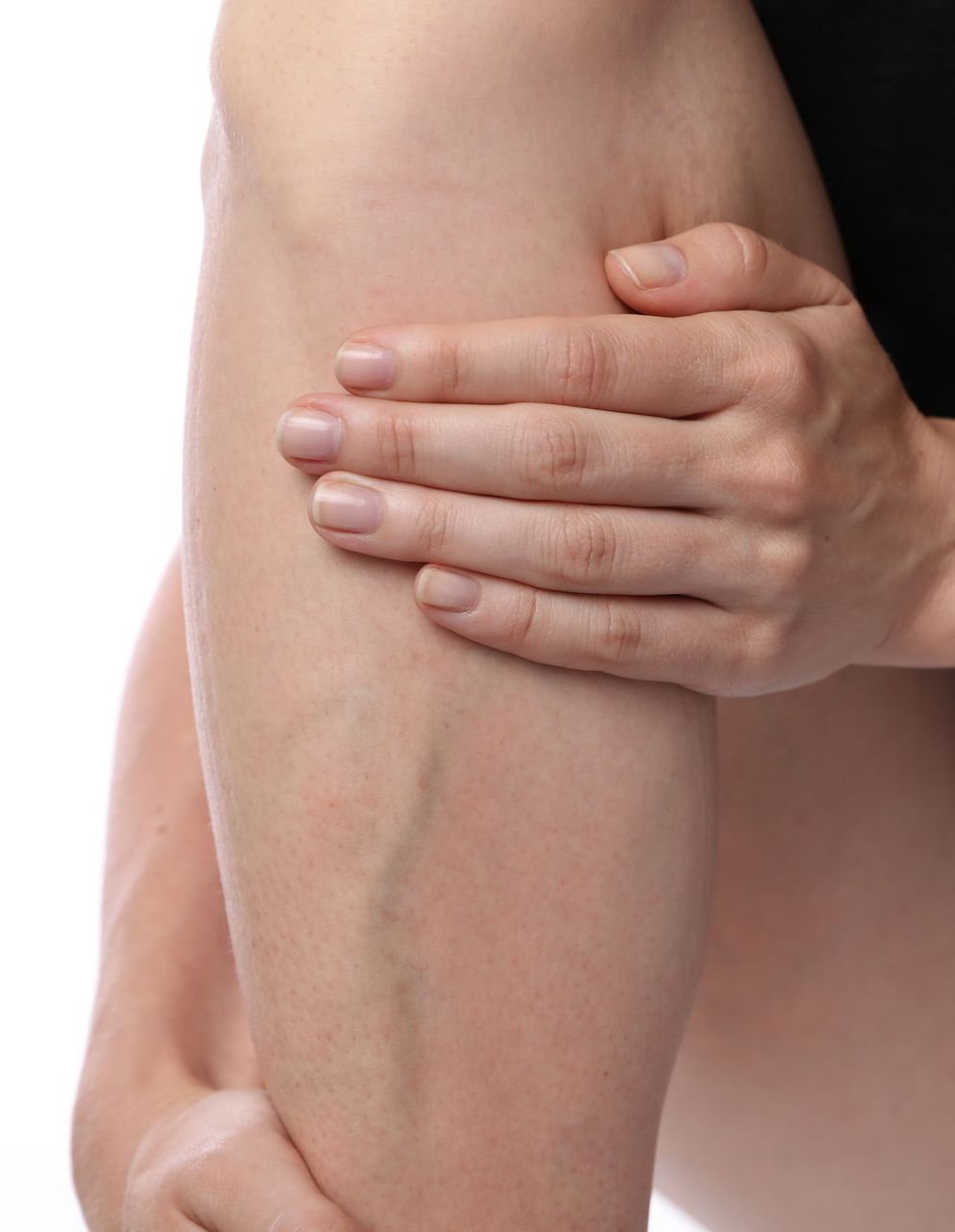 woman pointing at the veins on her leg