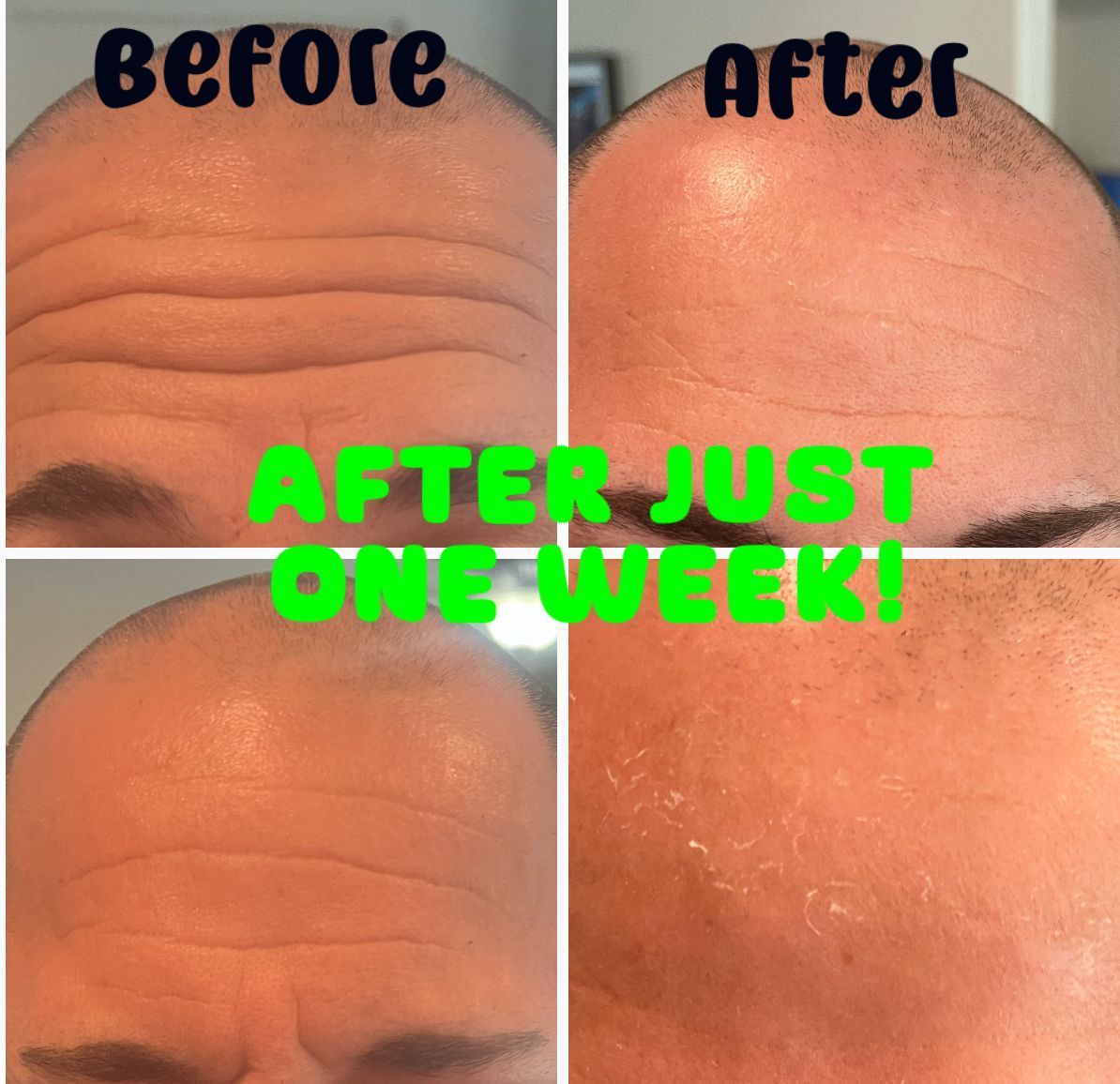 mans face after getting botox.  before and after photos