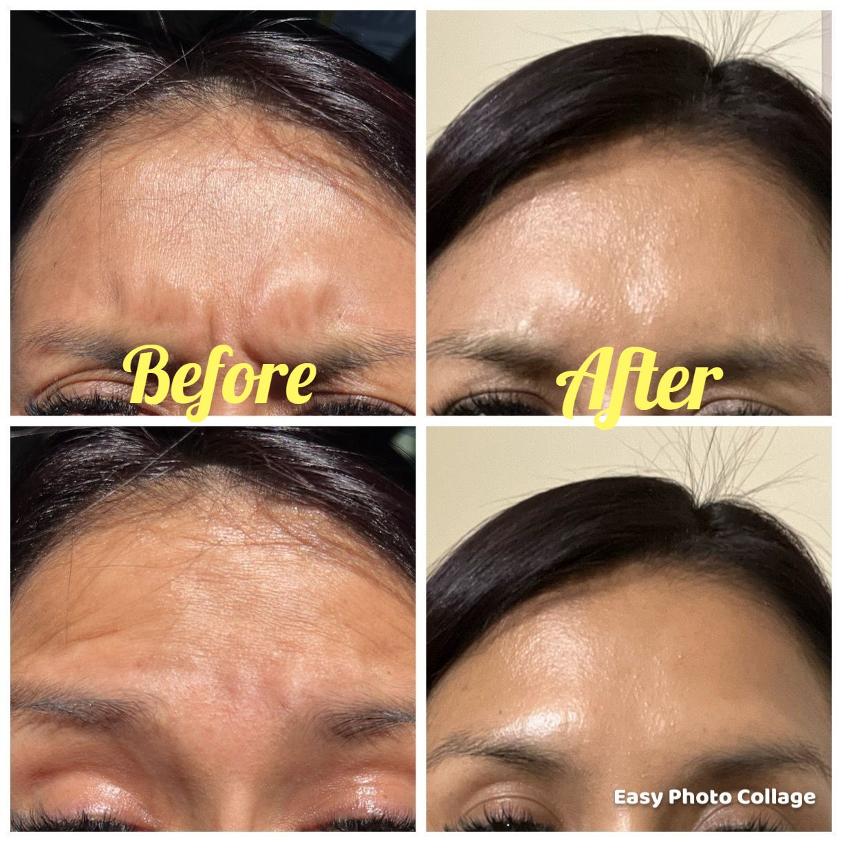 womans forehead, before and after photos after receiving botox