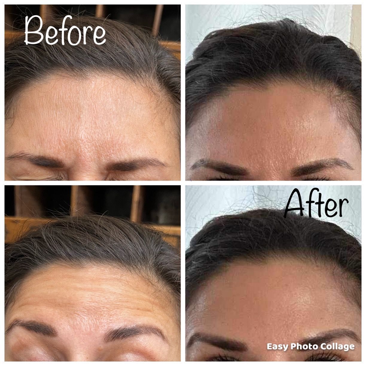 womans forehead who received botox, before and after photos 
