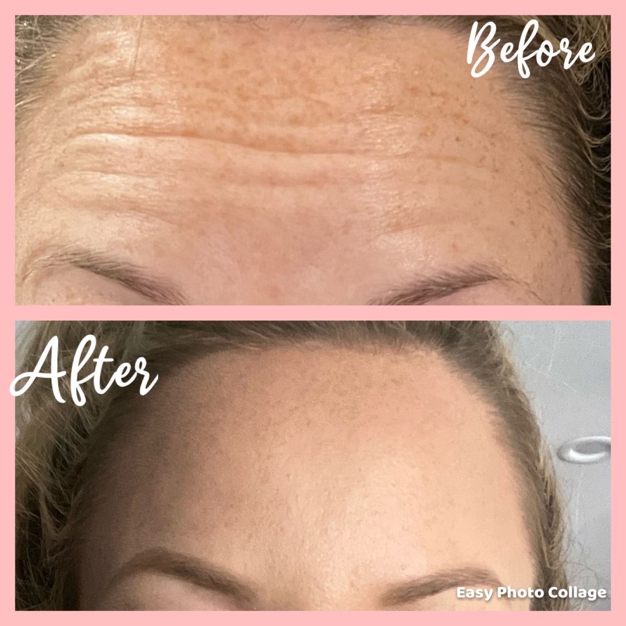 womans forehead before and after photos after receiving botox 