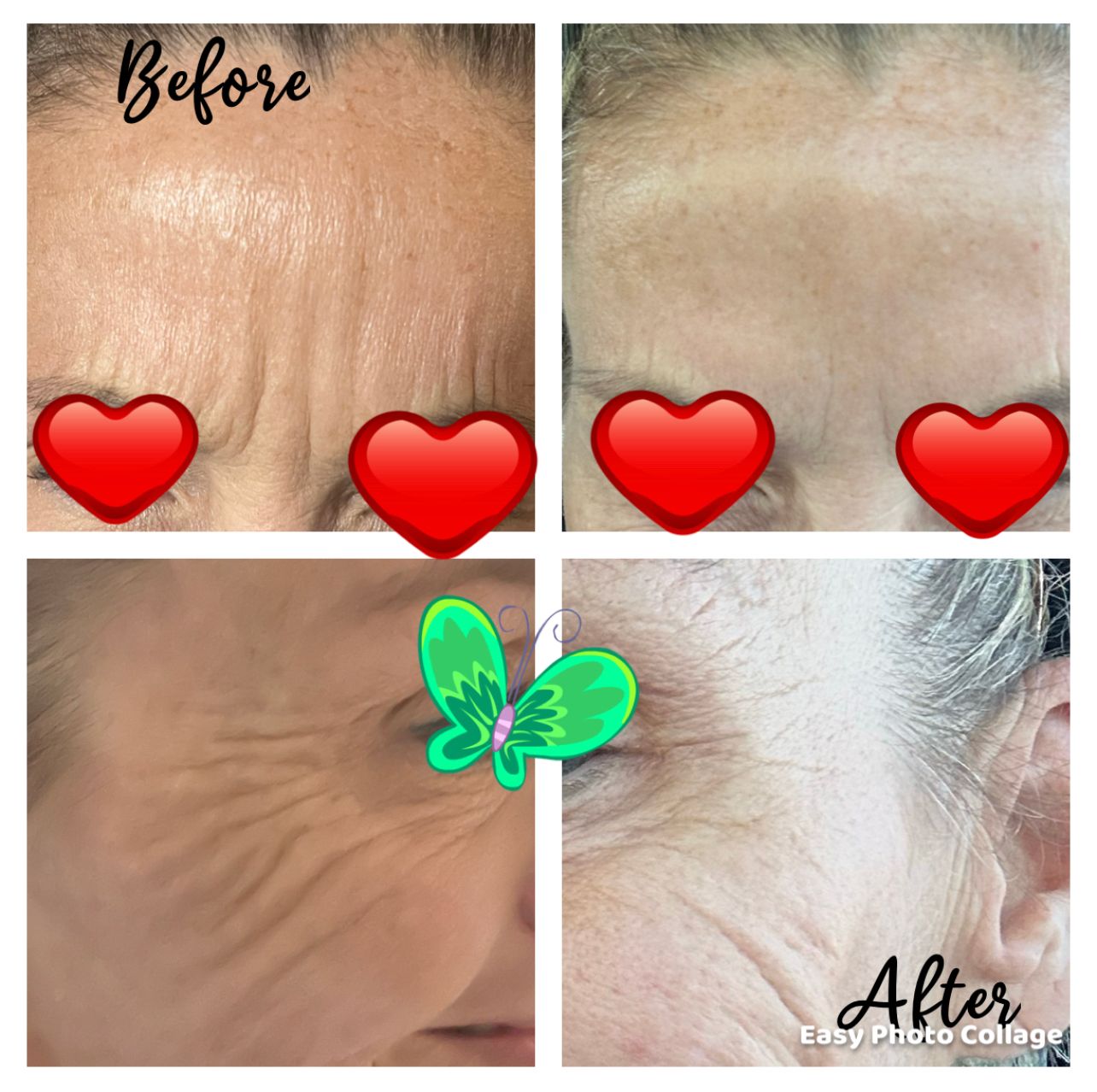 before and after photos of a womans improvement from botox 