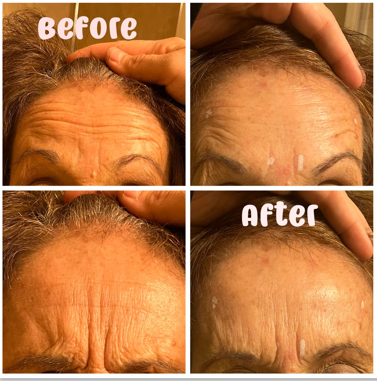 older lady's before and after photos after receiving botox. 