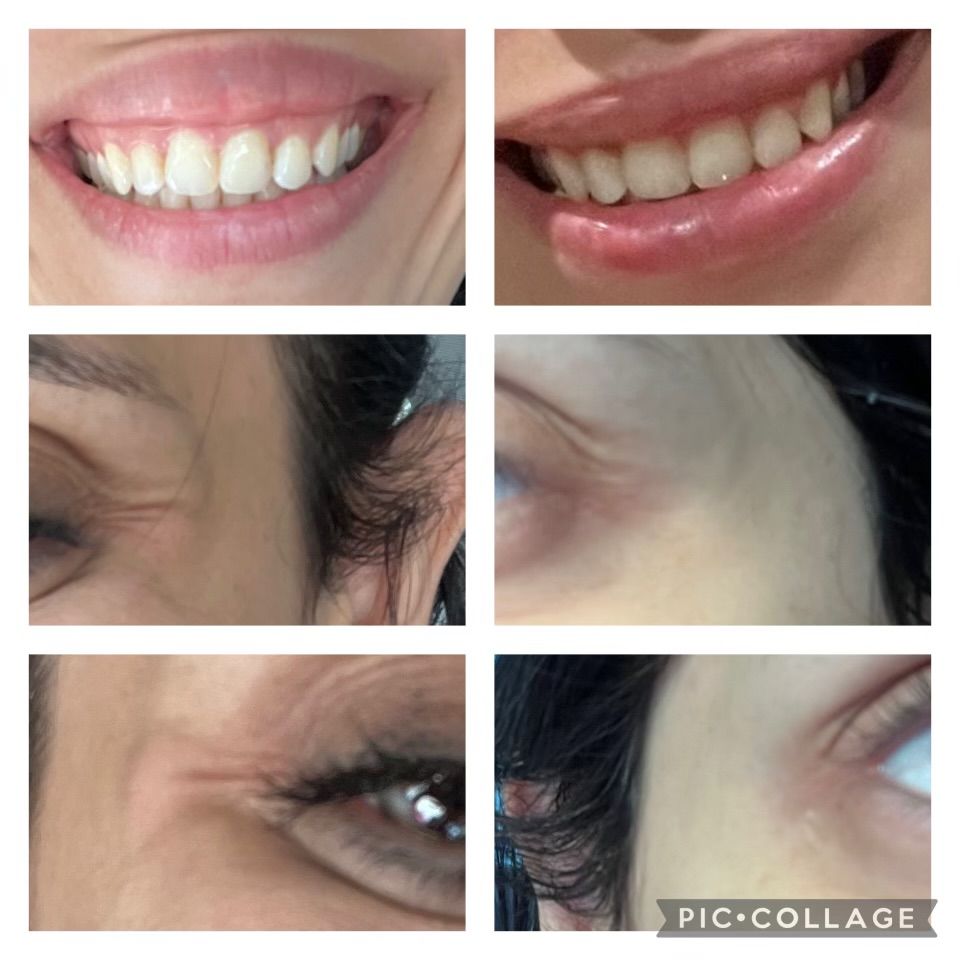 a womans before and after photos after receiving botox 
