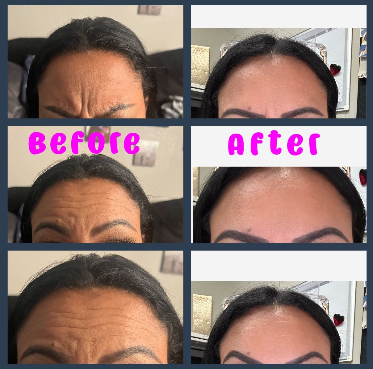 womans face before and after photos, she received botox 