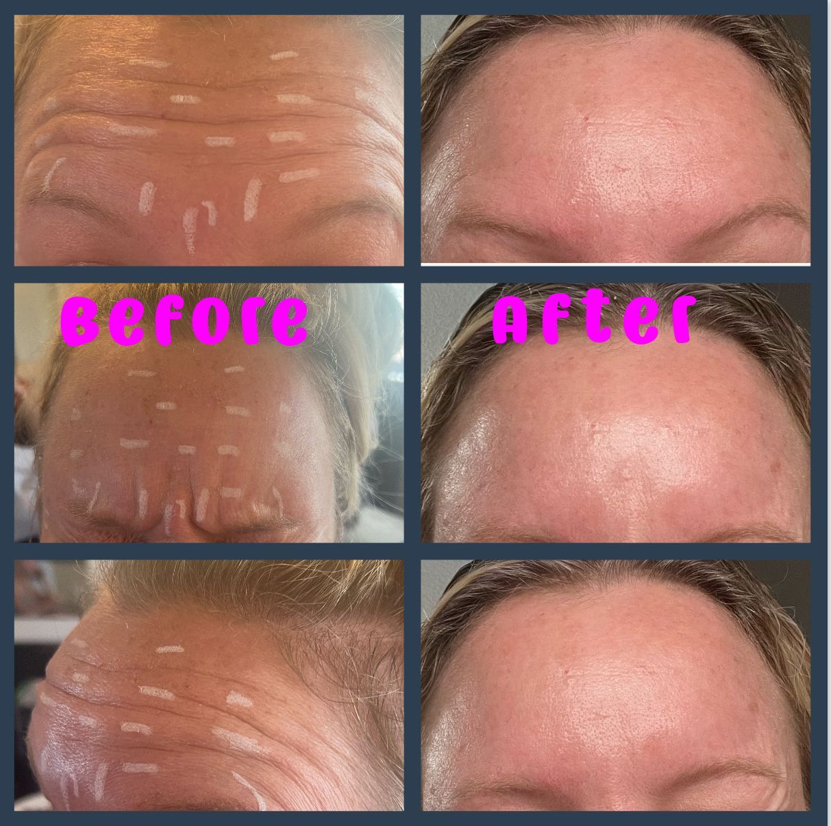 before and after photos of a woman who received botox 