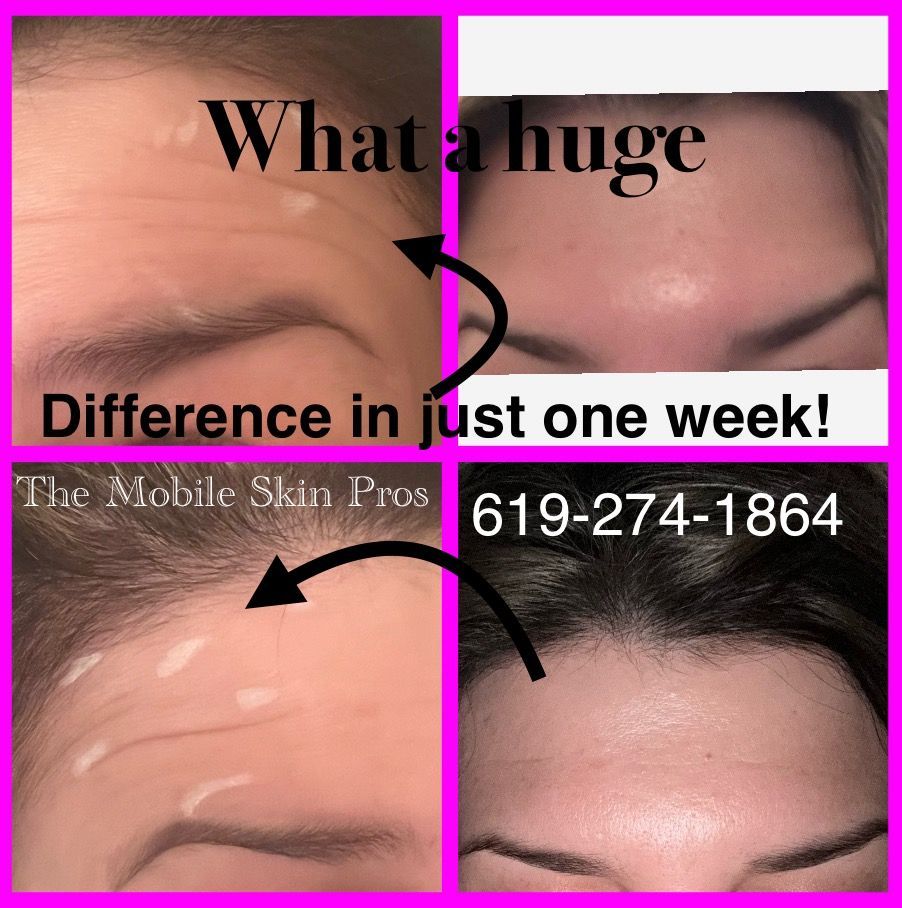 womans face who received botox, before and after photos.