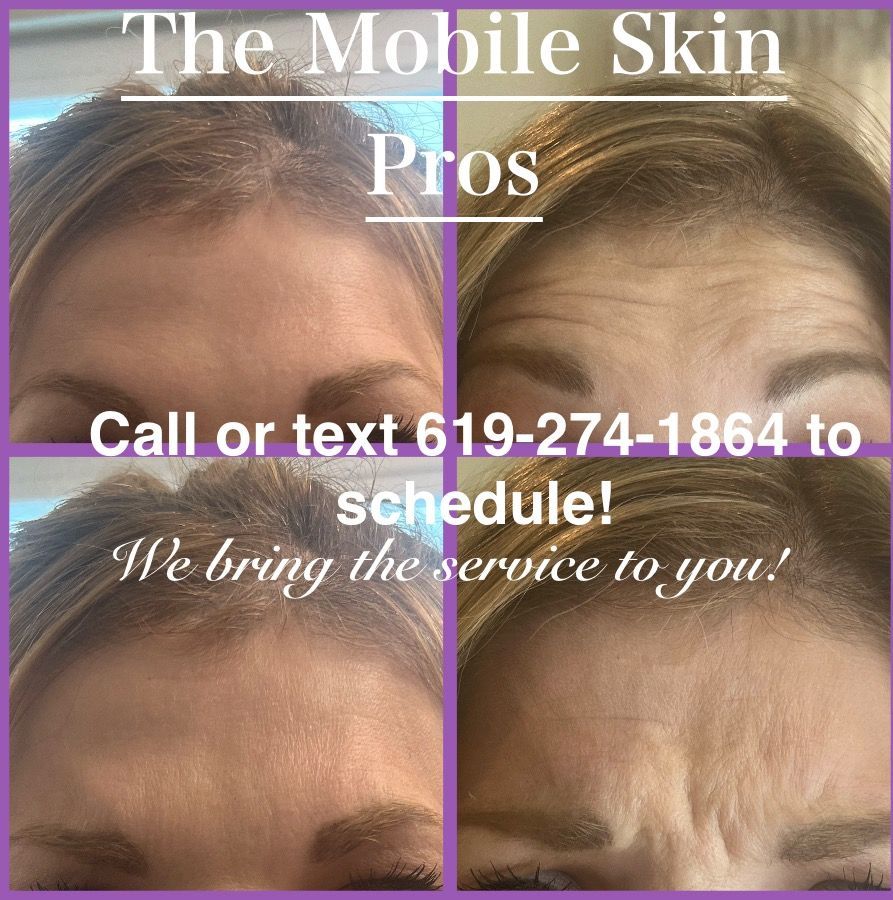 womans forehead who received botox.  before and after photos 