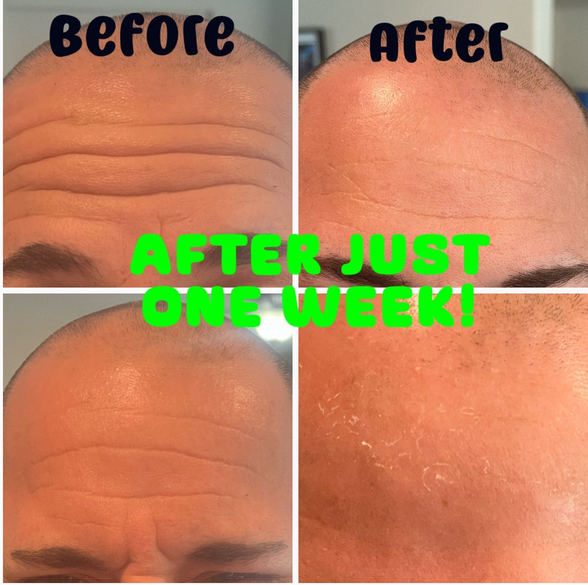 mens before and after photo after receiving botox 