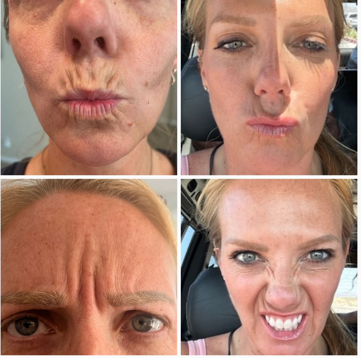 womans before and after photos, woman is puckering her lips so that she can see the improvements from a lip flip 