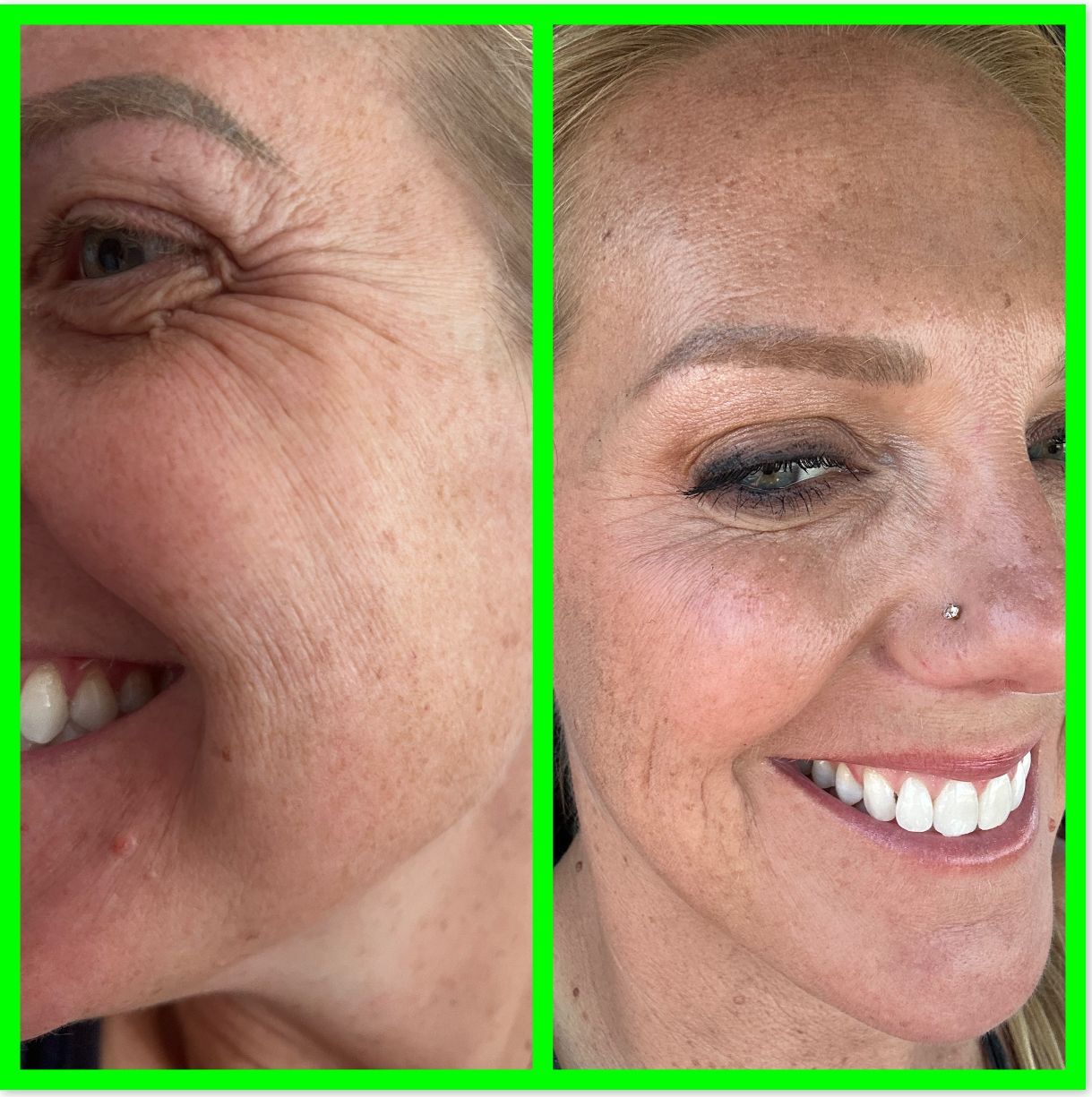 womans face after receiving botox, 