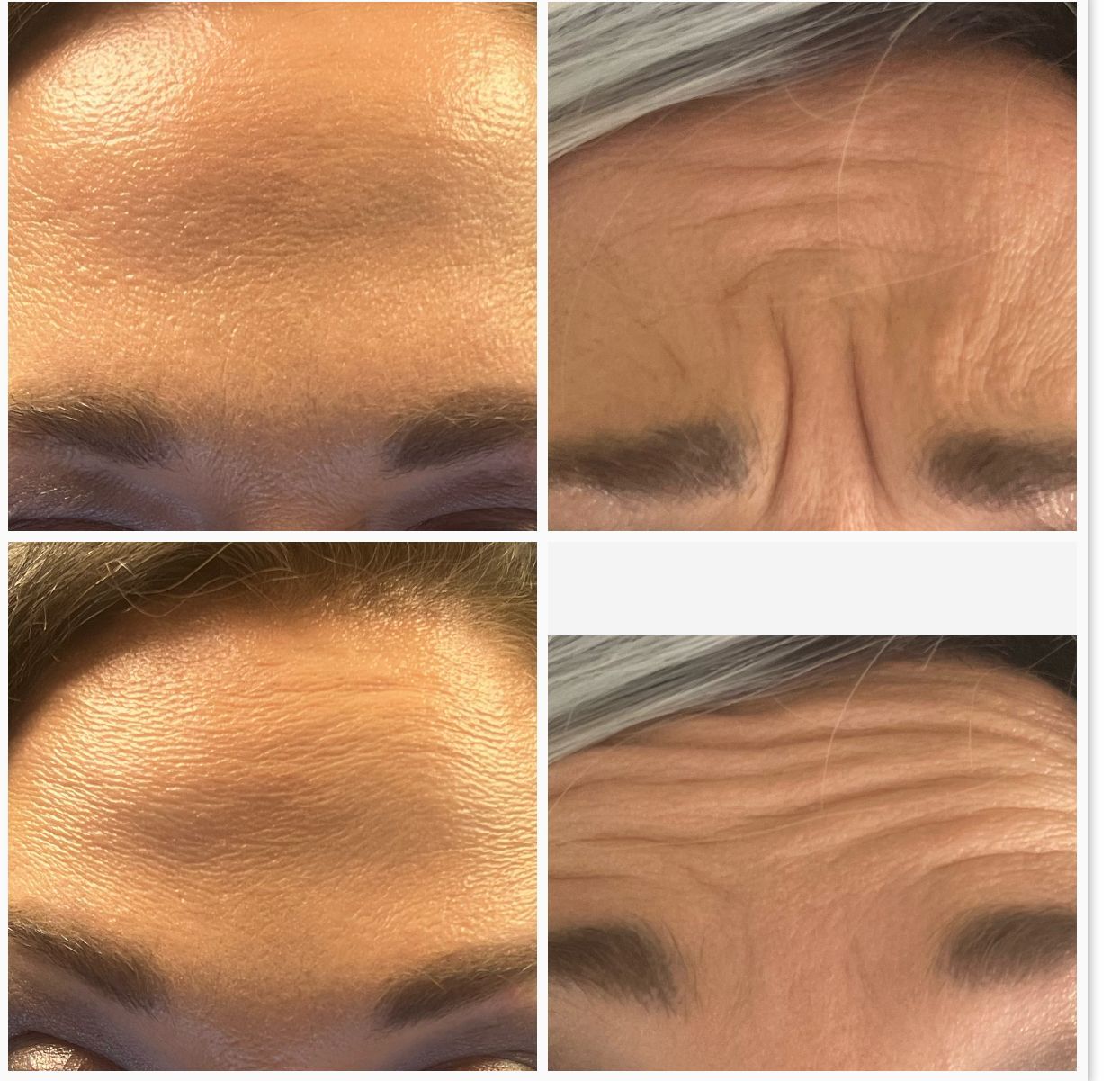 before and after photos of someone showing her results from receiveing botox 