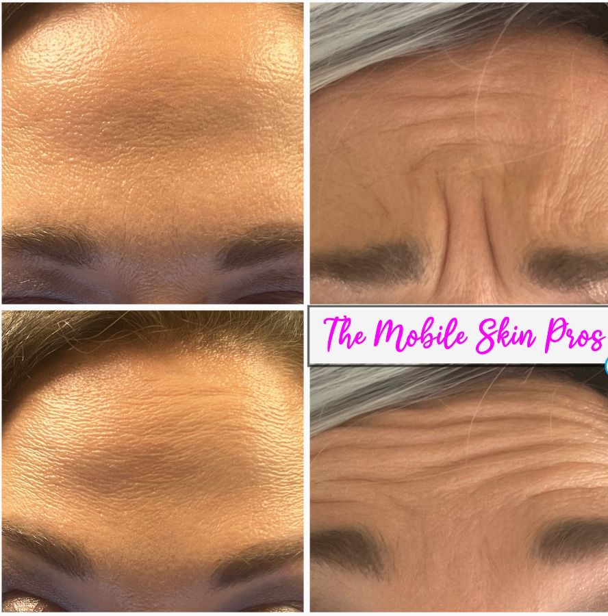 before and after of someone who received botox (on left) and wanted to show her results
