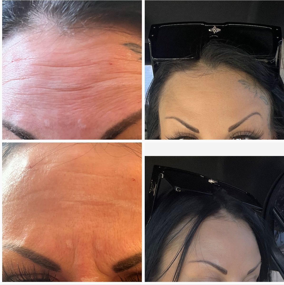 womans face before and after photos, with her eyebrows lifted to show her results from botox 