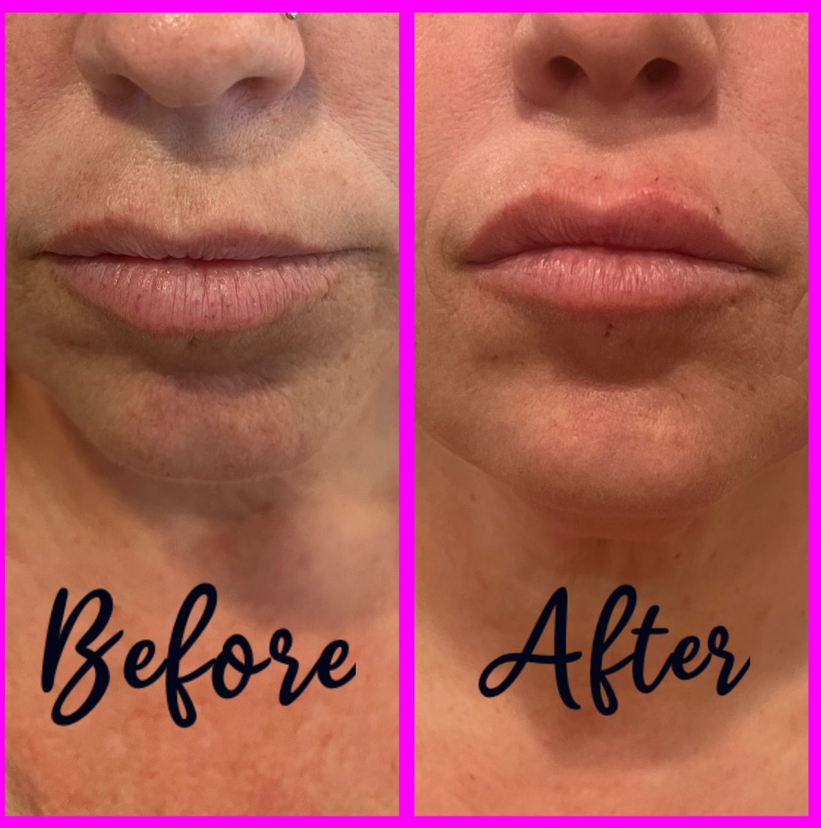 womans before and after photos of when she got her lips done.  