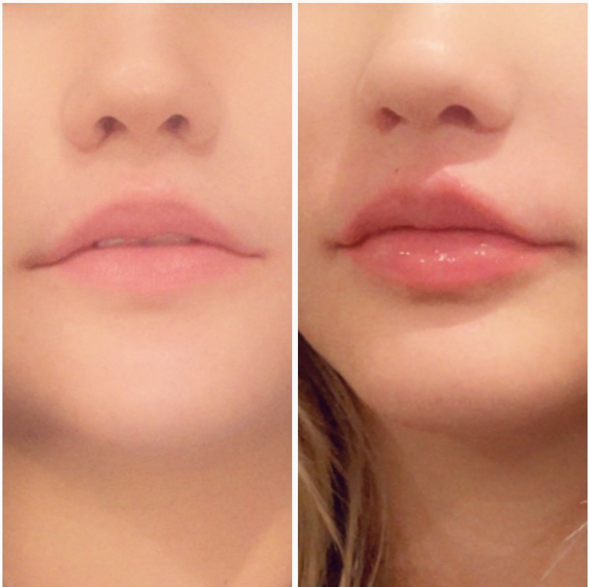 woman wanted her lips done in a very natural way.