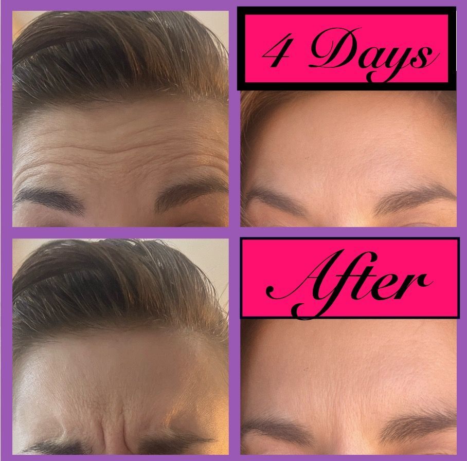 before and after photos of woman who got botox. 