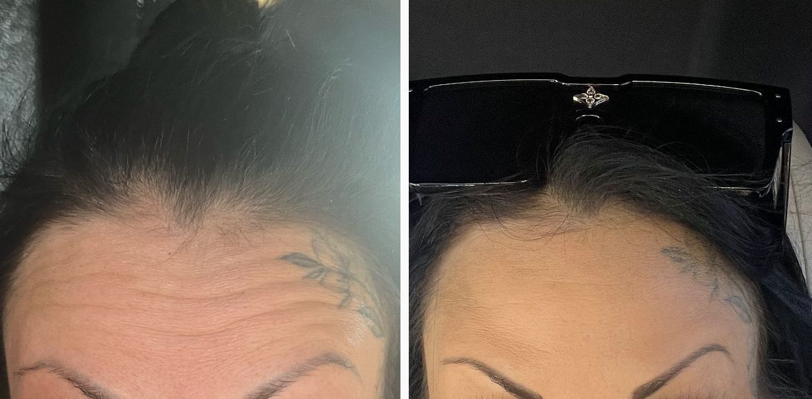 womans face with eyebrows up trying to show us her results from botox.