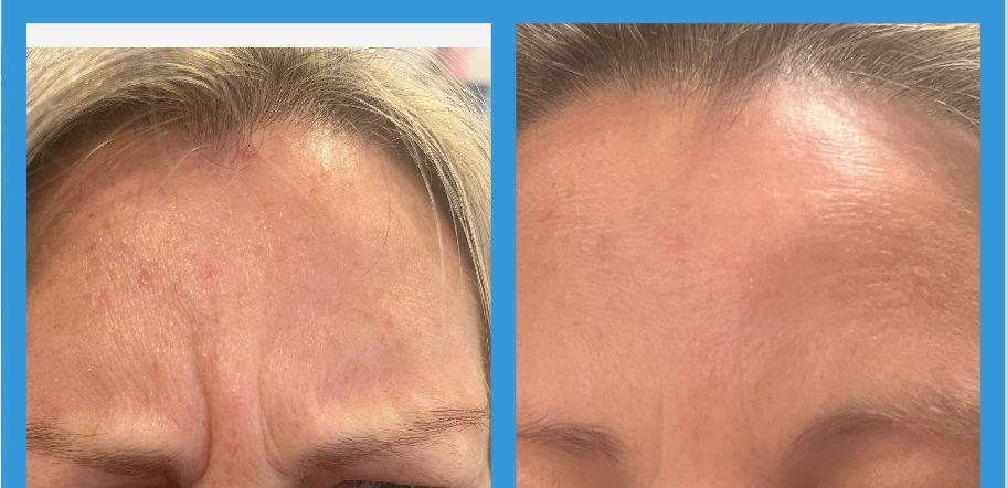 womans before and after photos to show her improvement after botox injections