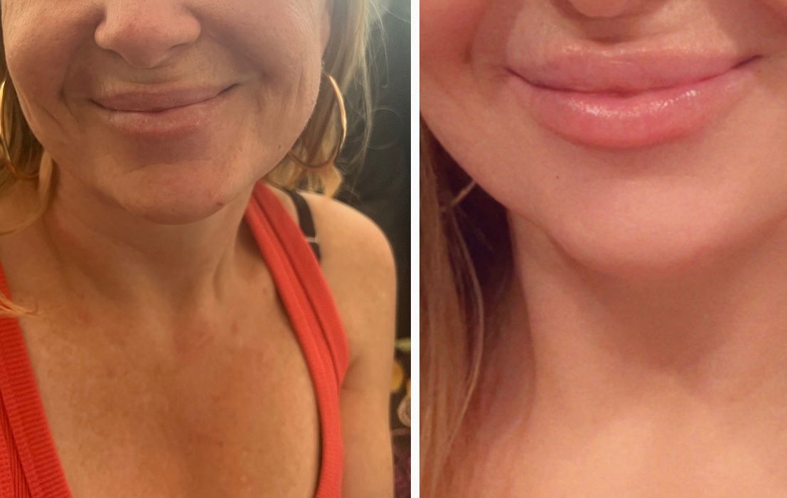 womans before and afters from them wanting to get their lips done.  
