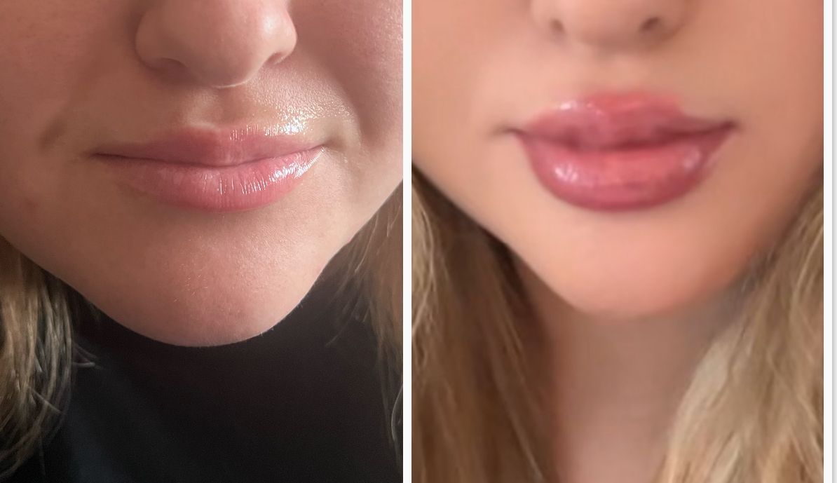before and after photos of a woman got her lips done with filler 