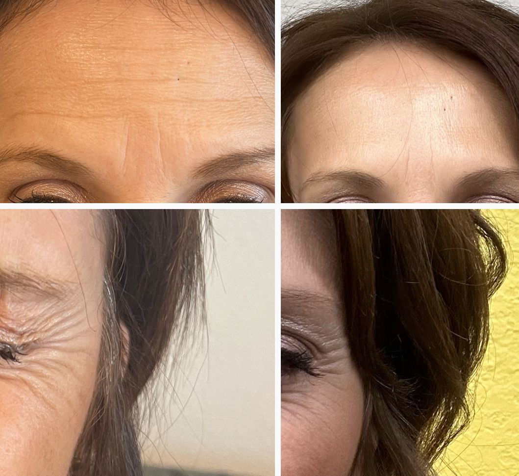 older clients before and after photos to show her improvement from botox