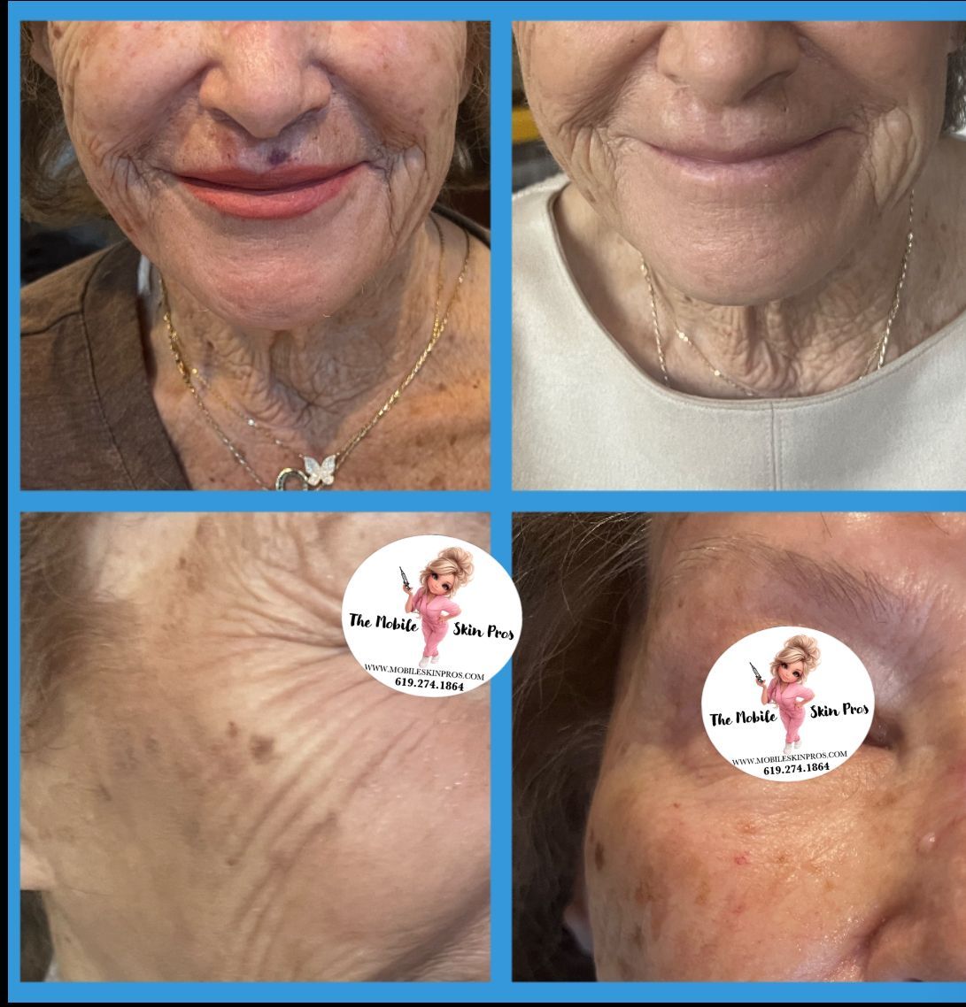 before and after photos of older client who received botox treatment