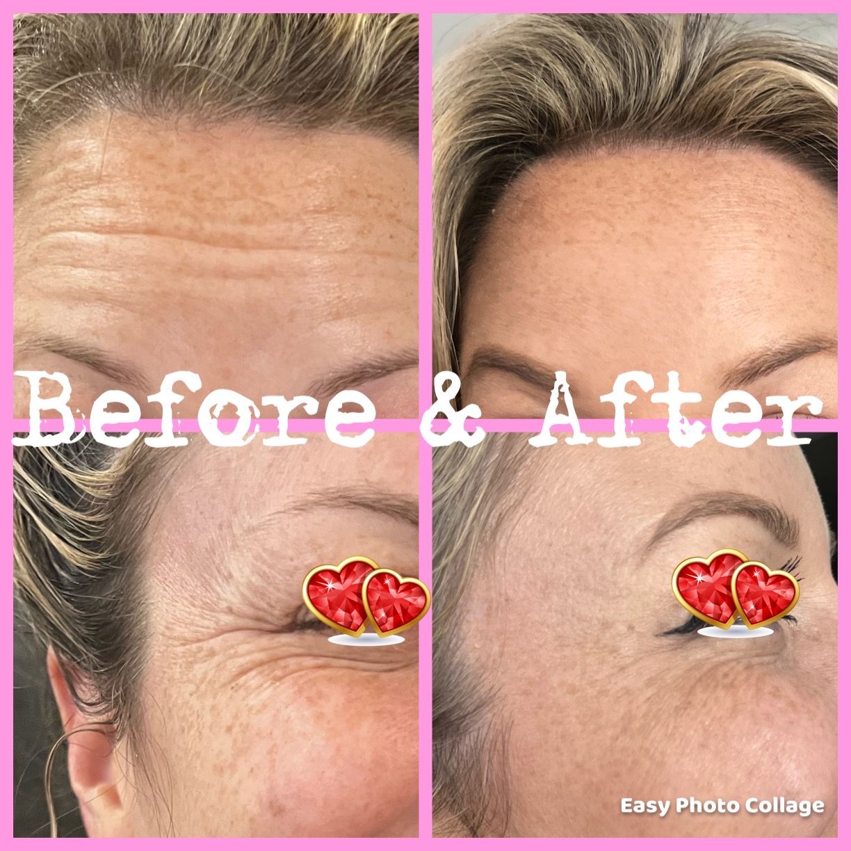 womans forehead and side photo to show how much improvement she had with botox 
