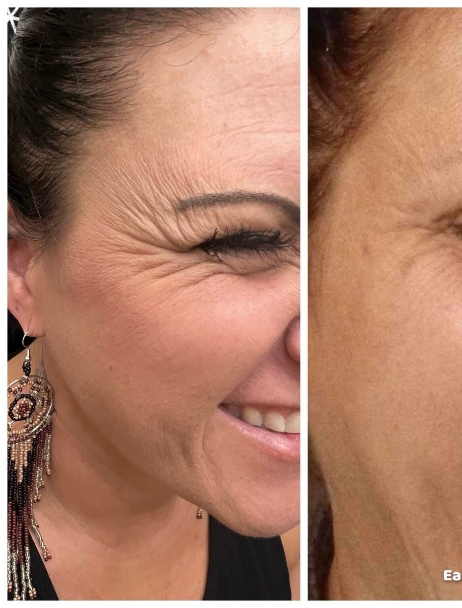 womans face exaggerating crows feet on the left side and then another image of the woman showing improvement from botox.  