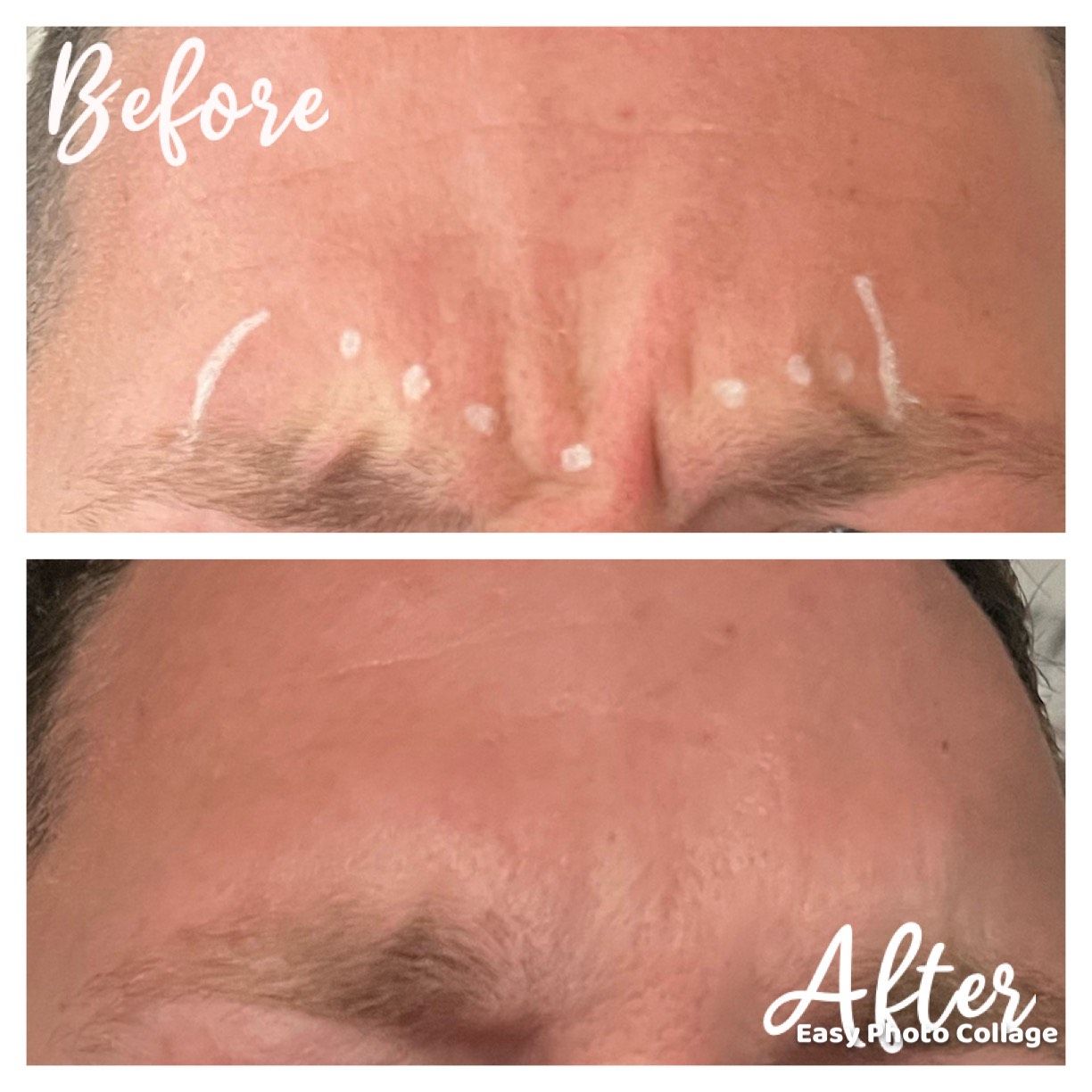 mans forehead that received botox.  before and after photos