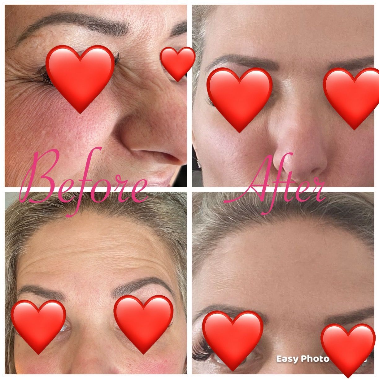 before and after photos of a woman after botox treatment