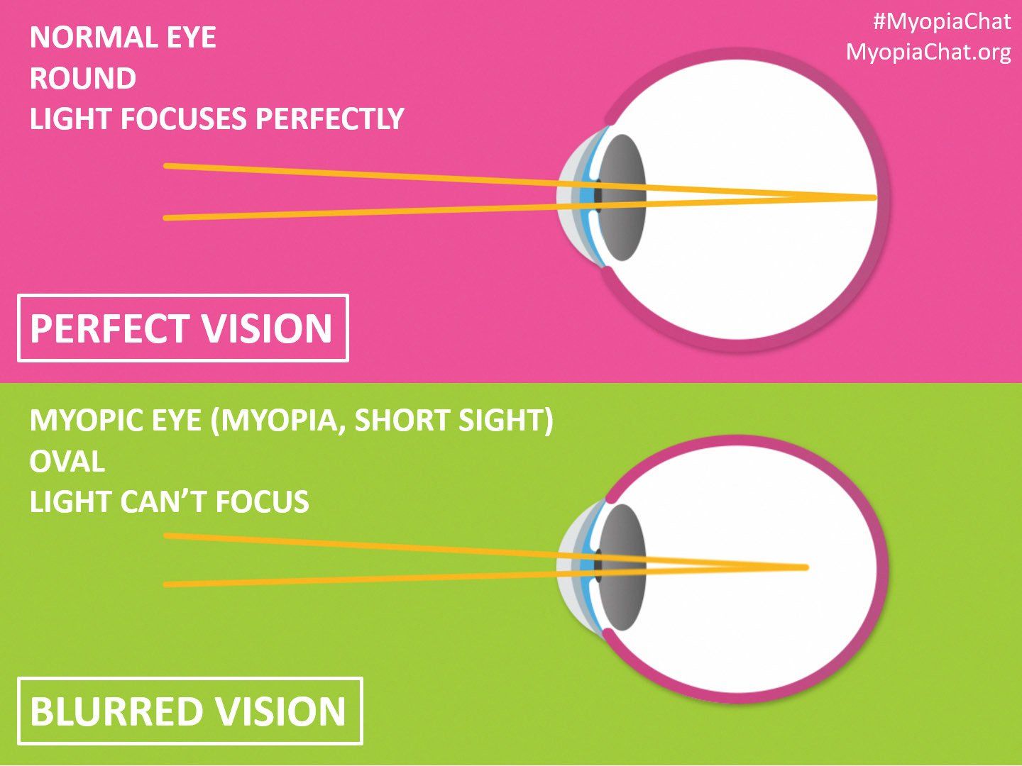 Myopia Management Image