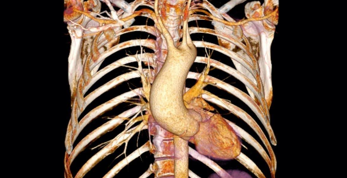 Tomografia médica 3D mostrando o coração humano e a aorta dentro da caixa torácica, renderizados em tons de marrom e bege contra um fundo preto.