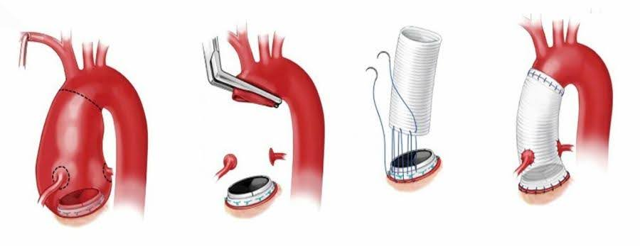 Diagrama ilustrando as etapas da cirurgia de substituição da válvula aórtica, mostrando a aorta, uma nova válvula e a sutura.