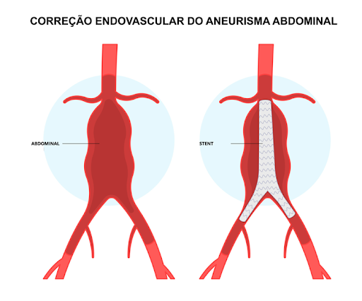 Diagrama ilustrando o reparo endovascular de um aneurisma abdominal; aorta vermelha com protuberância antes e endoprótese depois.